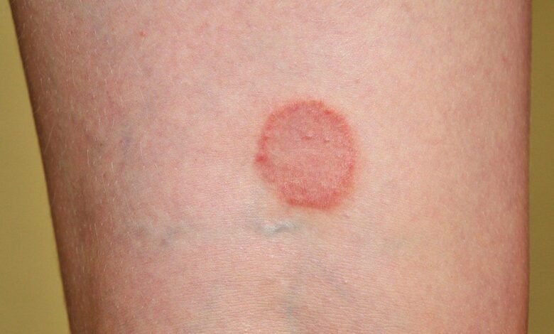 diabetic rash